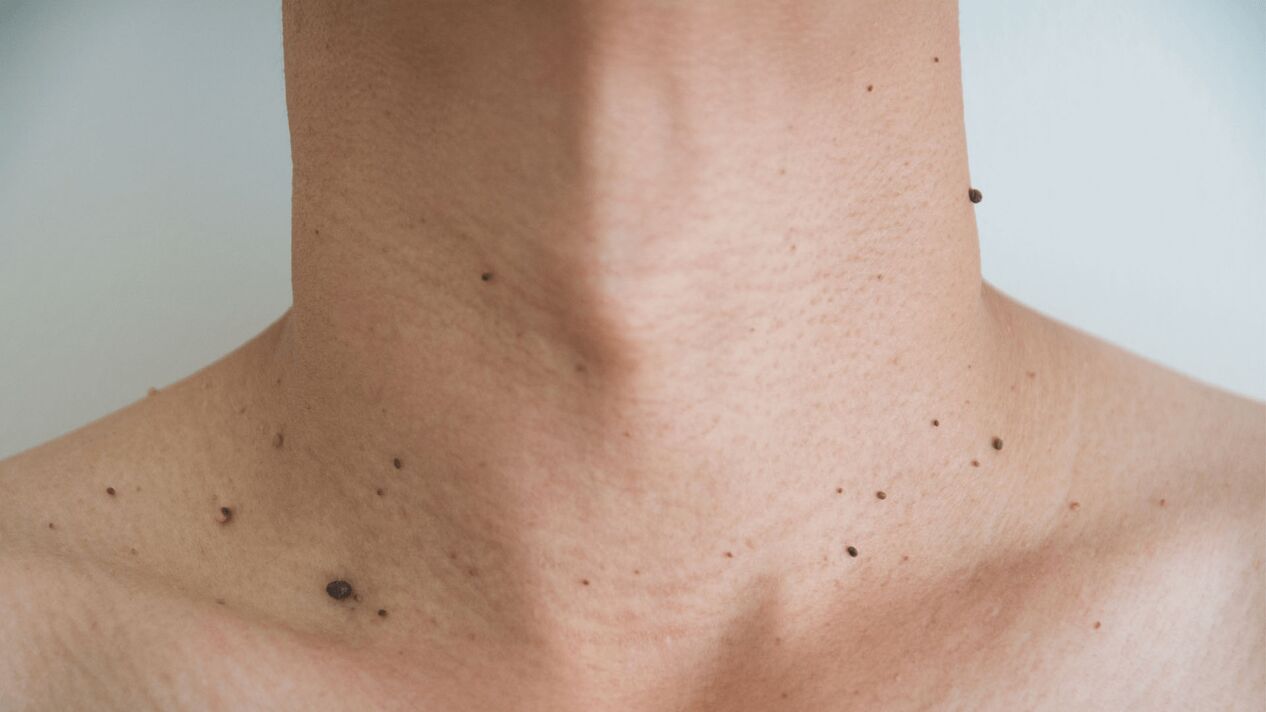 Keramin cream treatment for neck and chest papillomas
