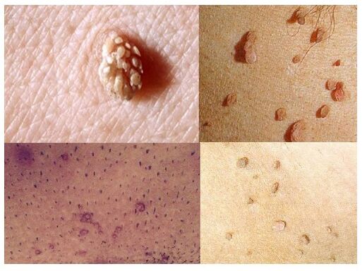 genital warts on the body
