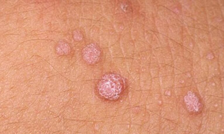 HPV leads to the appearance of skin papillomas