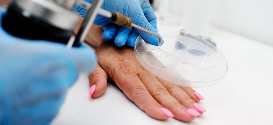 professional wart removal available