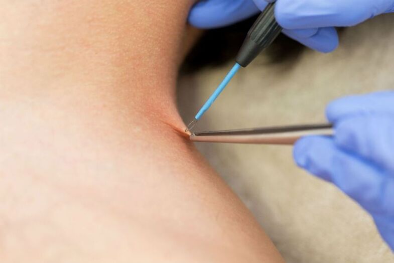 The procedure for removing papilloma by electrocoagulation