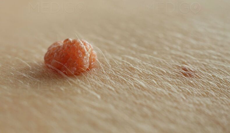 skin papilloma