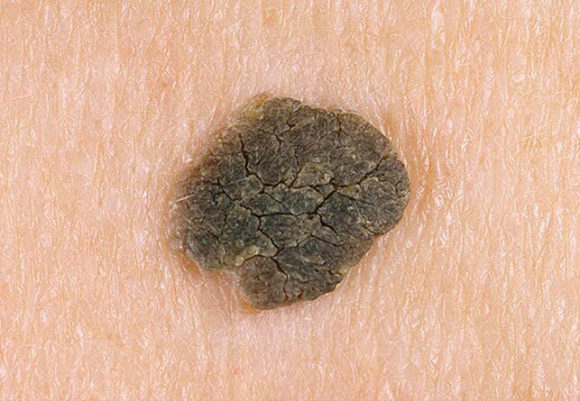 black wart on the skin