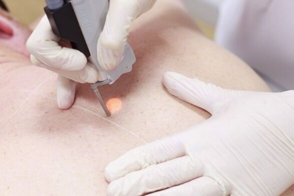 A popular method to remove papillomas with laser