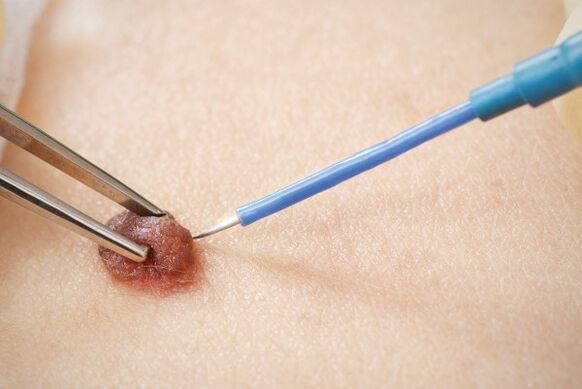Papilloma electrocoagulation