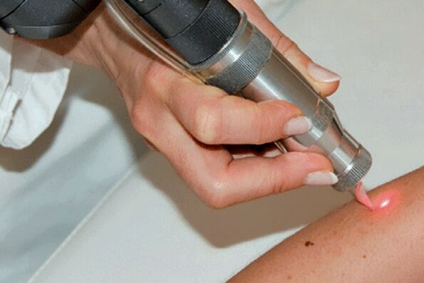 Papilloma laser removal