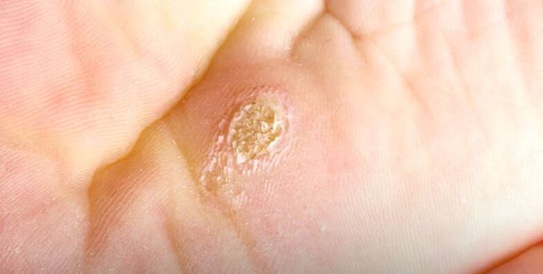Plantar wart (spinal wart)