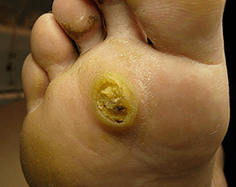 Subian papillomas